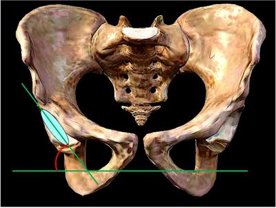 Does the limb lengthening reduce the incidence of hip dislocation in patients with neurological disorders and insufficient muscle tension who undergoing hip arthroplasty?